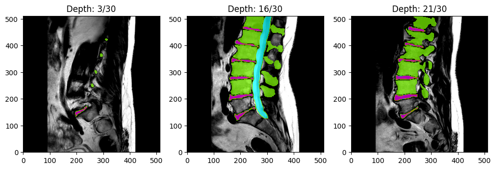 Example MRI Image with Segmentation Mask