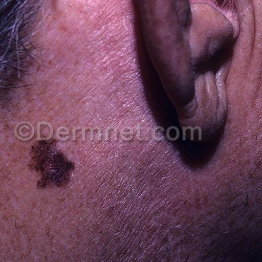 malignant-melanoma-123.jpg