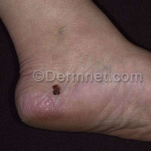 malignant-melanoma-19.jpg