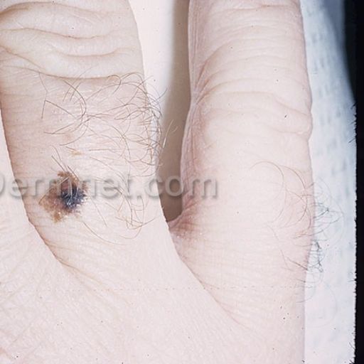 malignant-melanoma-80.jpg