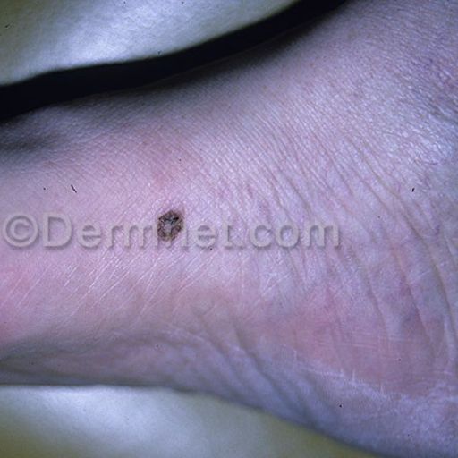 malignant-melanoma-81.jpg