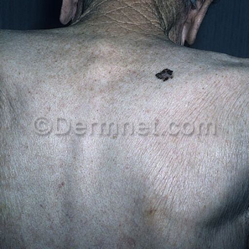 malignant-melanoma-9.jpg