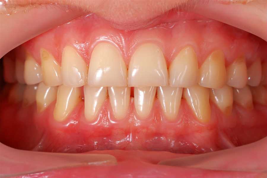 Aligned Teeth